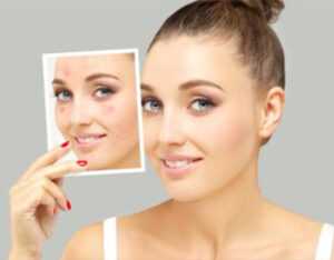 Acne Scar Treatment Melbourne | Melbourne Clinical Laser